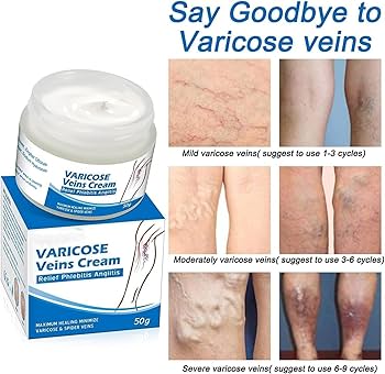 Crema Elimina Varices EXITO VENTAS 2025