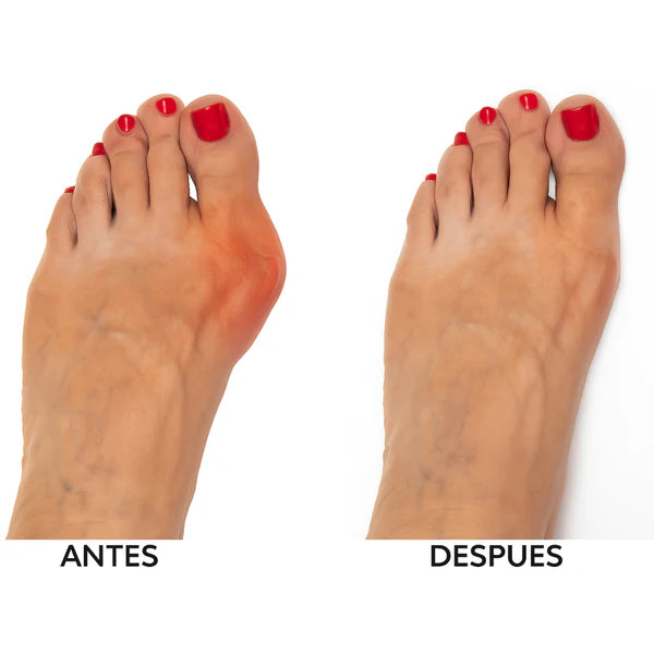 Corrector de Juanetes - Hallux™