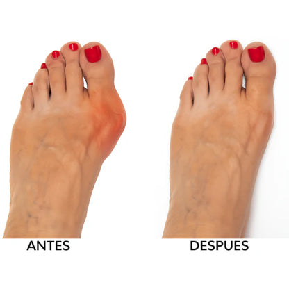 Corrector de Juanetes - Hallux™