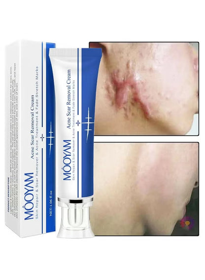 Crema para eliminar todas las cicatrices EXITO VENTAS